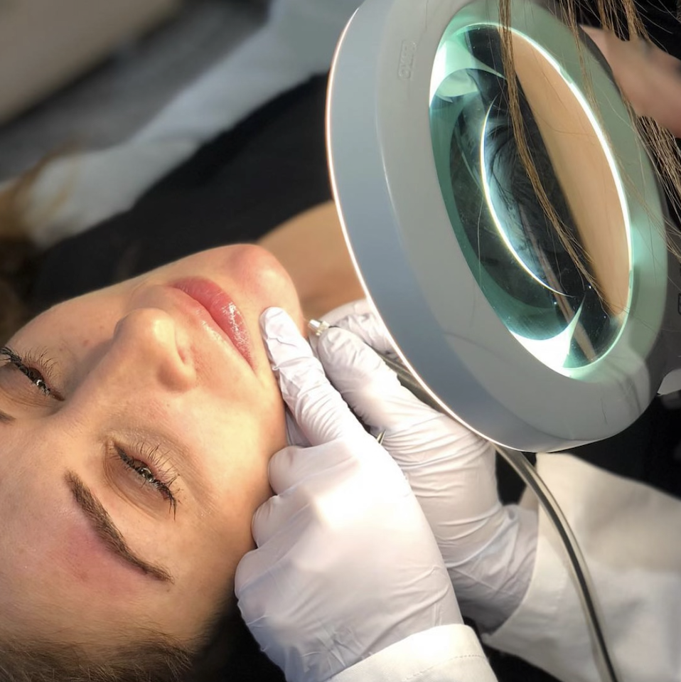 Photo of Electrolysis hair removal being performed on chin of a young lady.